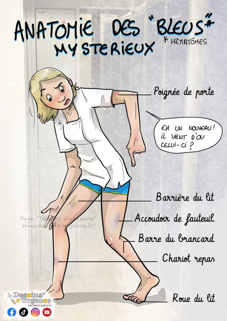 Infirmière avec des bleus sur les jambes